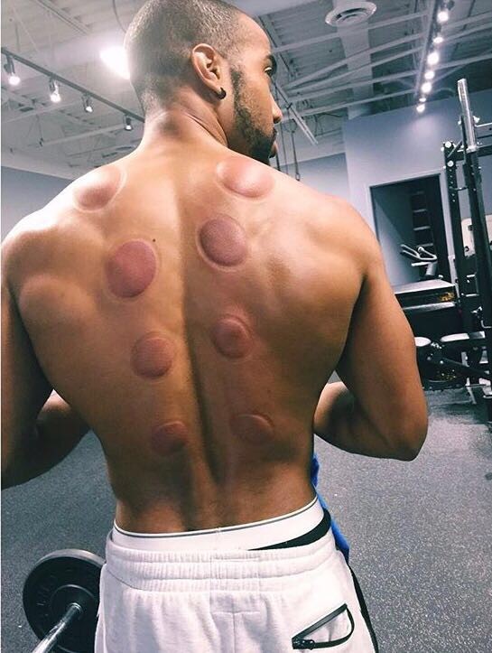 Cupping for Athletes & Sport Performance