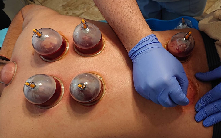 Hijama Wet Cupping Therapy
