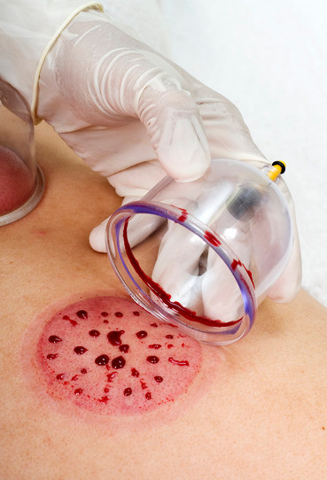 Hijama for varicose and spider veins