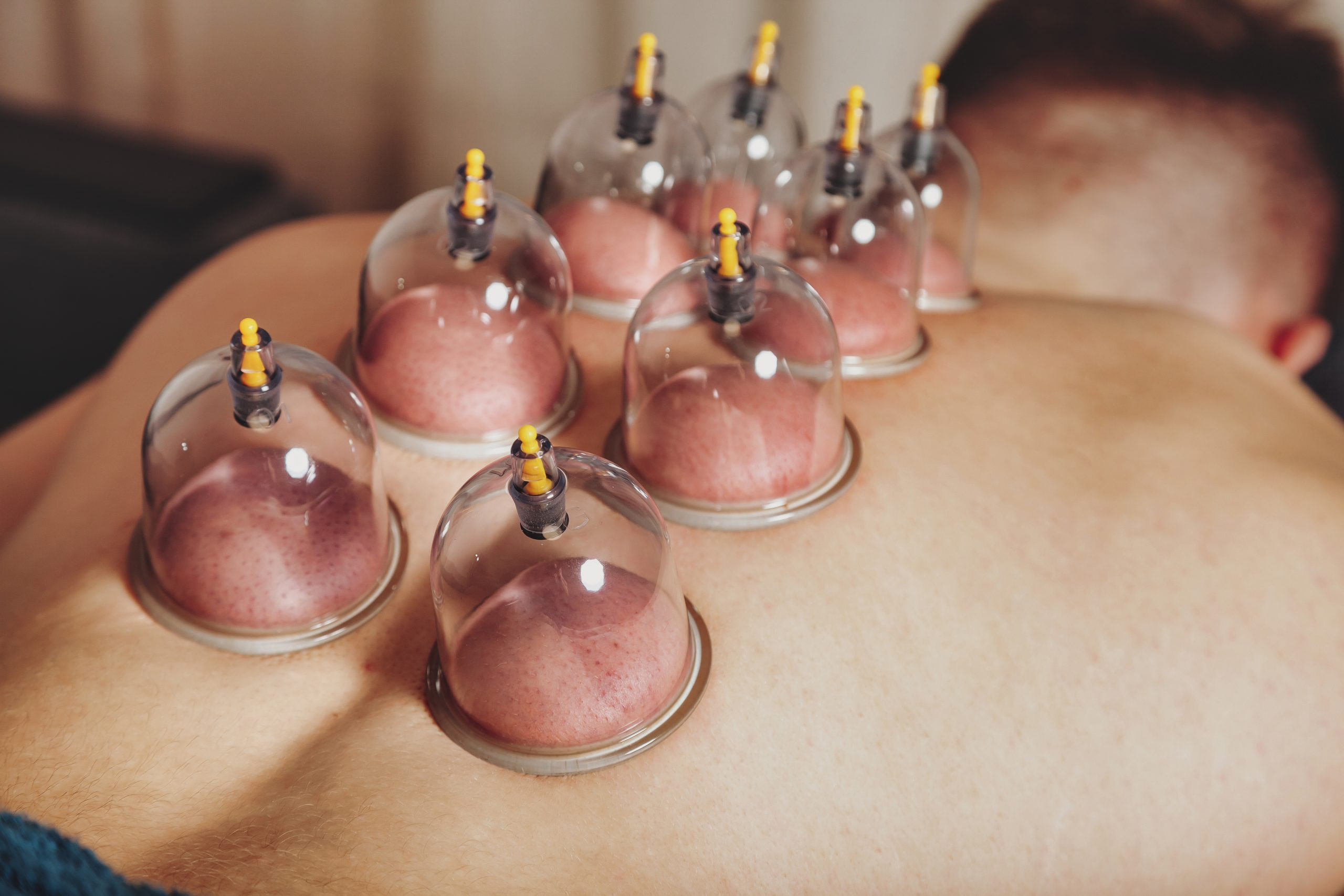 Nerve mobilization cupping