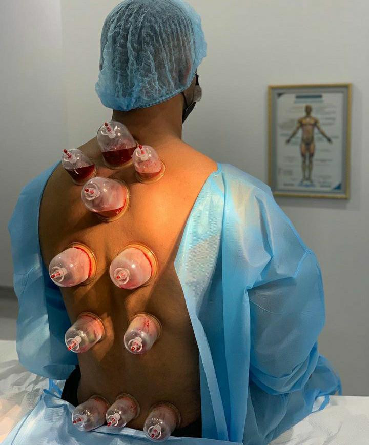 Hijama sunnah cleanse